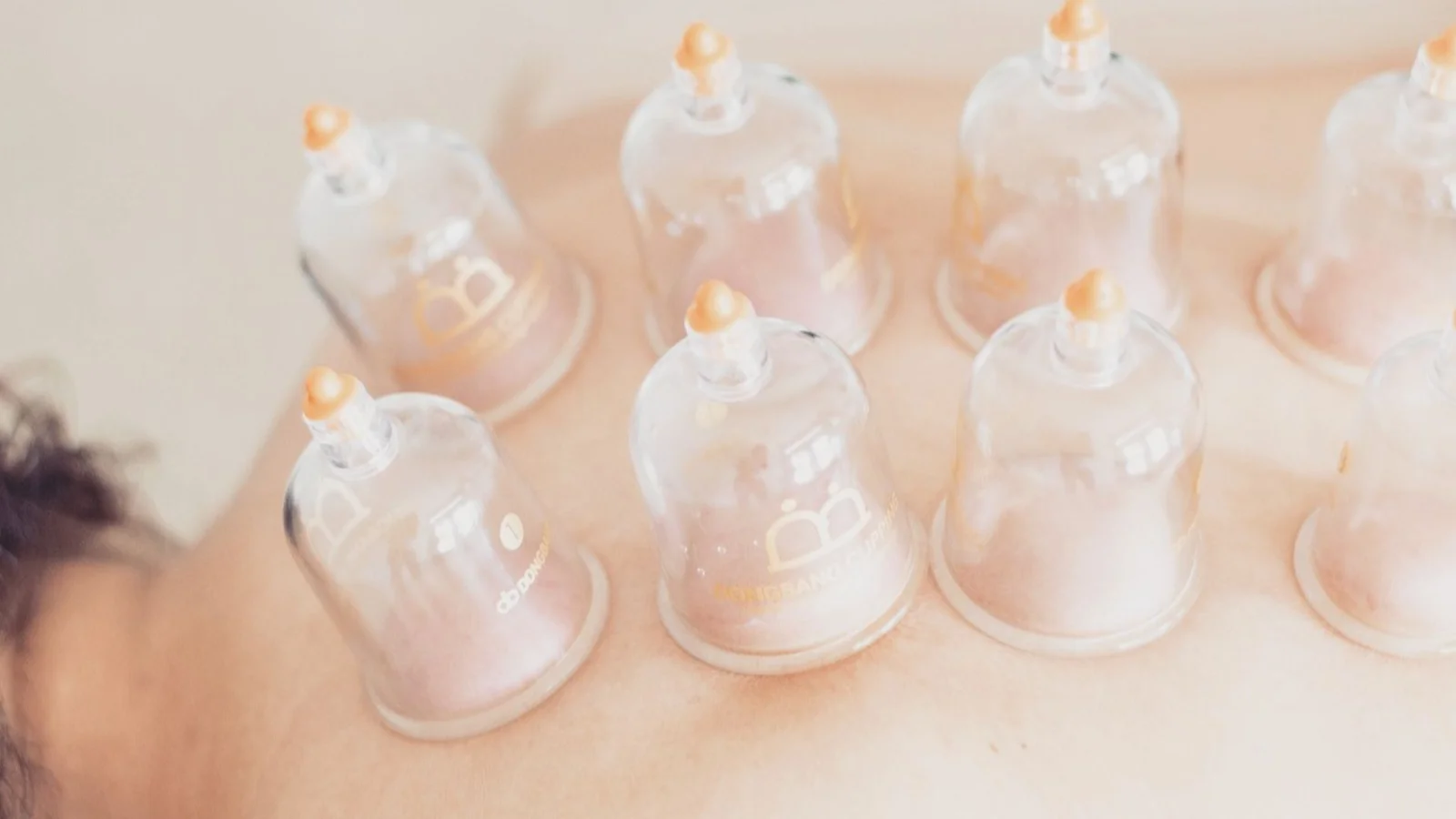 Lykkensminde Ergoterapi & Massage tilbyder nu cuppingterapi