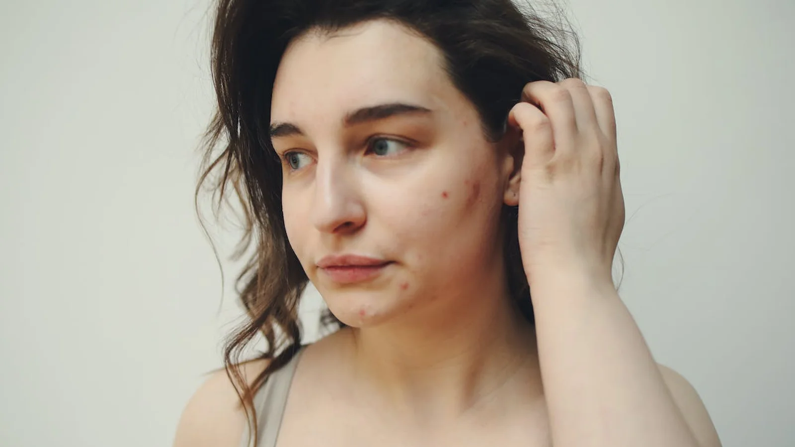Døjer du med akne? Så kan Vita Nova Skincares Akne Fond måske hjælpe